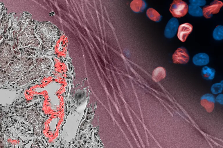 Amyloidosis_RodrigoGallardo